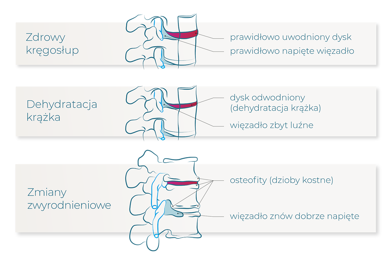 proces zwyrodnieniowy kregoslupa dehydratacja krazka dysku