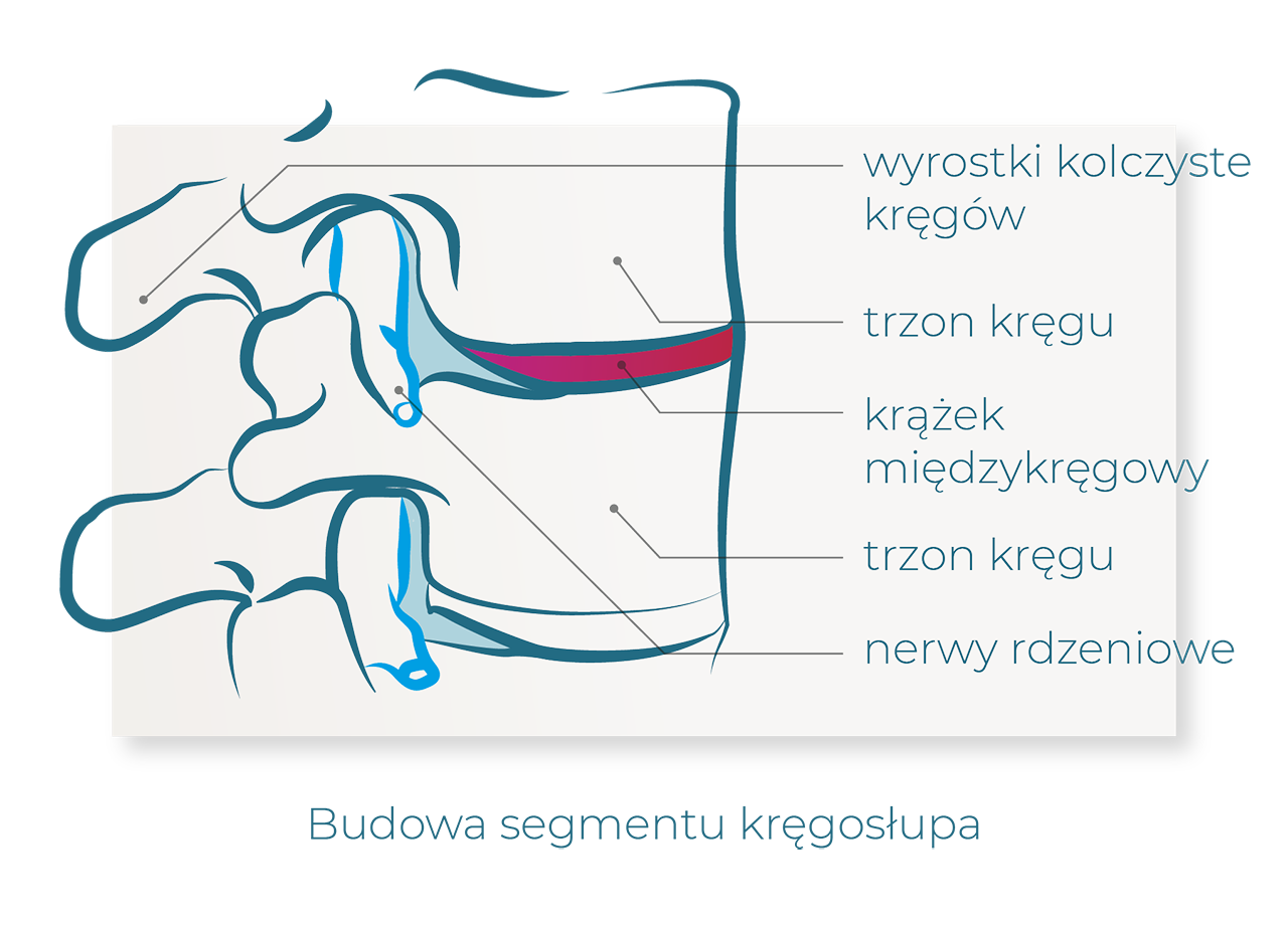 dyskopatia leczenie objawy przyczyny budowa segmentu kręgosłupa wypadający dysk kręgosłup