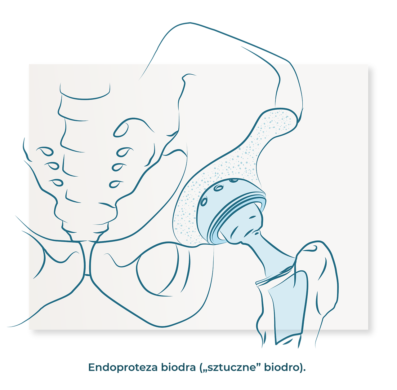 endoproteza biodra sztuczne biodro