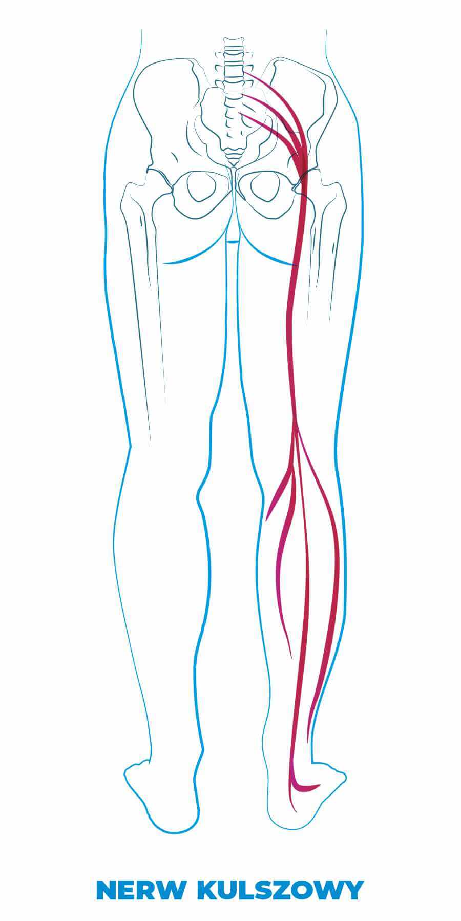 Rwa kulszowa, nerw kulszowy, objawy rwy kulszowej, ból nogi